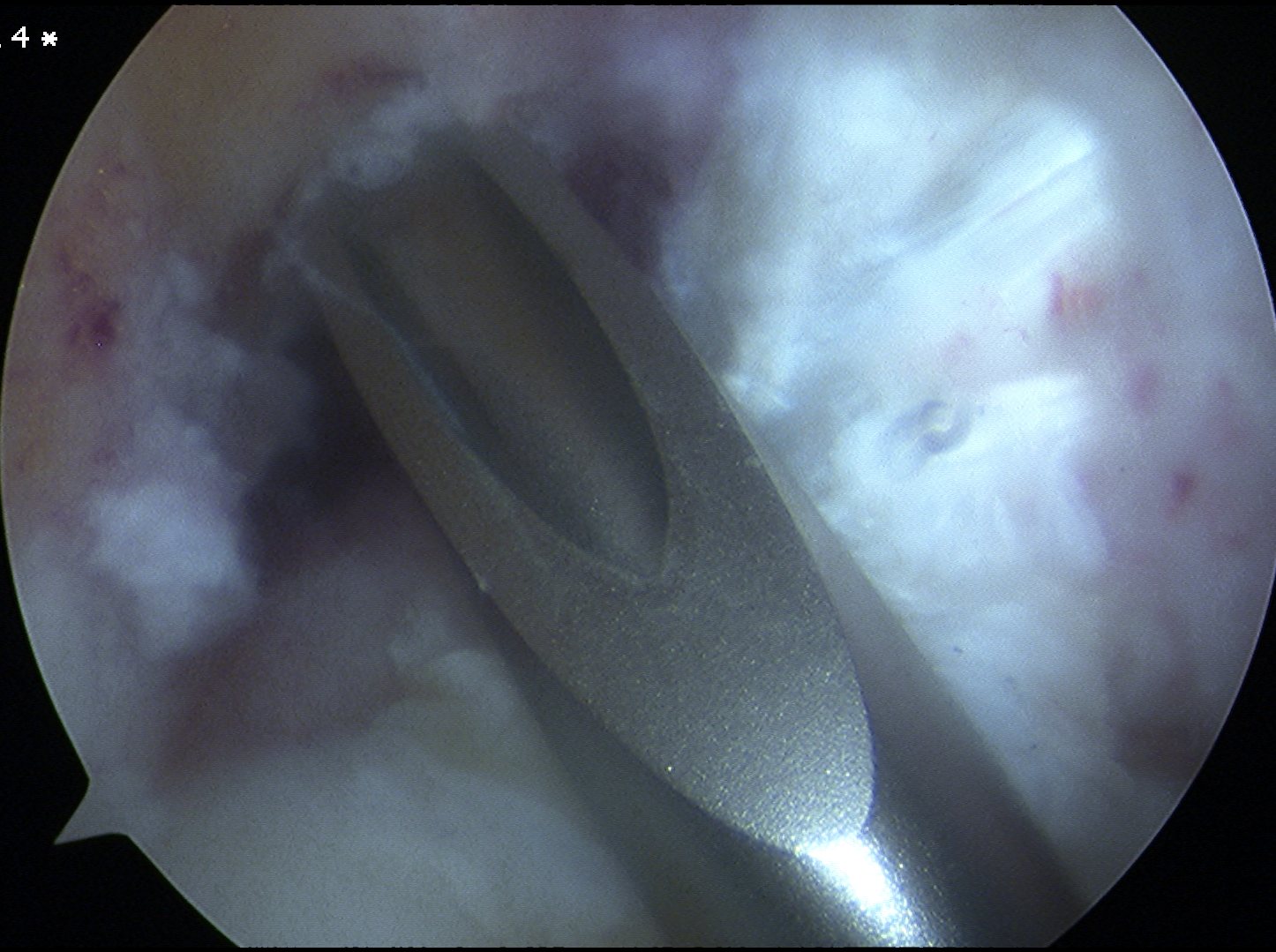 ACL Femoral Offset Guide